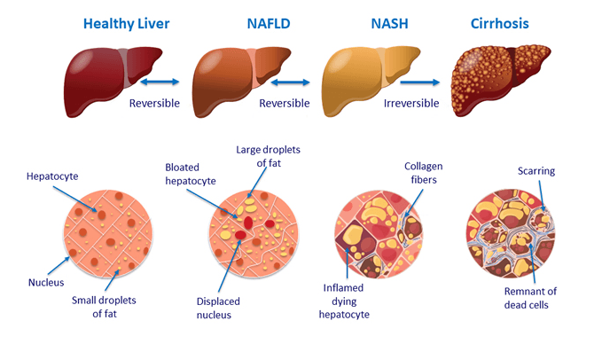 Fatty Liver Disease (ALD, NAFLD, NASH) - Natural Health Connections